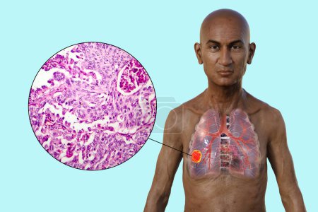 Photo for A 3D photorealistic illustration of the upper half part of a man with transparent skin, revealing the presence of lung cancer, along with a micrograph image of lung adenocarcinoma. - Royalty Free Image