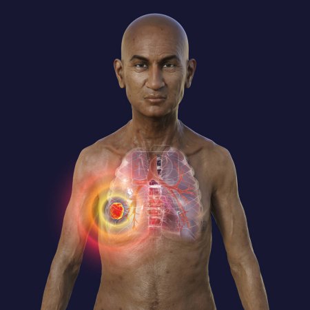 Photo for A 3D photorealistic illustration of the upper half part of a man with transparent skin, revealing the presence of lung cancer. - Royalty Free Image