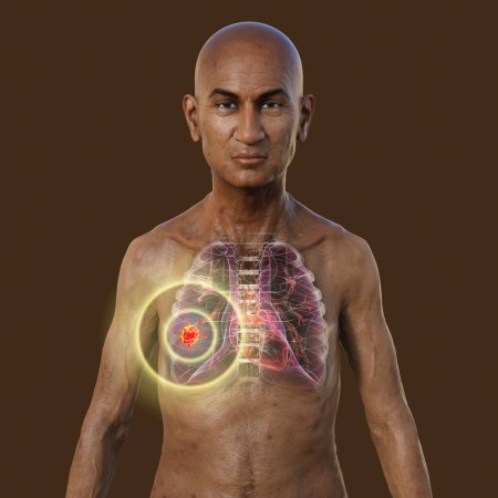 Téléchargez les photos : Illustration photoréaliste 3D de la moitié supérieure d'un homme à la peau transparente, révélant la présence d'un cancer du poumon. - en image libre de droit