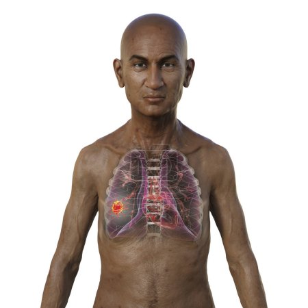 Téléchargez les photos : Illustration photoréaliste 3D de la moitié supérieure d'un homme à la peau transparente, révélant la présence d'un cancer du poumon. - en image libre de droit