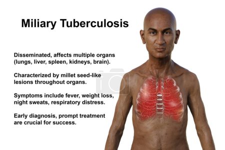 Téléchargez les photos : Illustration photoréaliste 3D de la moitié supérieure d'un homme à la peau transparente, mettant en valeur les poumons atteints de tuberculose miliaire. - en image libre de droit