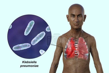 Téléchargez les photos : Illustration photoréaliste 3D montrant la moitié supérieure d'un homme à la peau transparente, révélant les poumons atteints de pneumonie, et vue rapprochée de la bactérie Klebsiella pneumoniae. - en image libre de droit