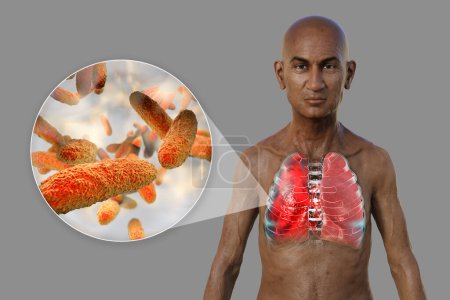 Foto de Una ilustración fotorrealista 3D que muestra la mitad superior de un hombre con la piel transparente, revelando los pulmones afectados por la neumonía, y la vista de cerca de la bacteria Klebsiella pneumoniae. - Imagen libre de derechos