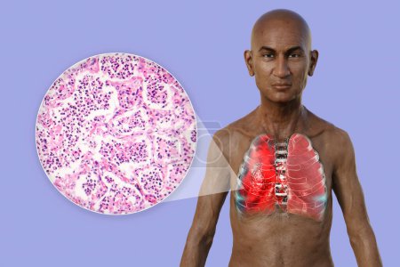 Foto de Una ilustración fotorrealista en 3D que muestra la mitad superior de un hombre con piel transparente, revelando los pulmones afectados por la neumonía, junto con una imagen micrográfica de neumonía. - Imagen libre de derechos