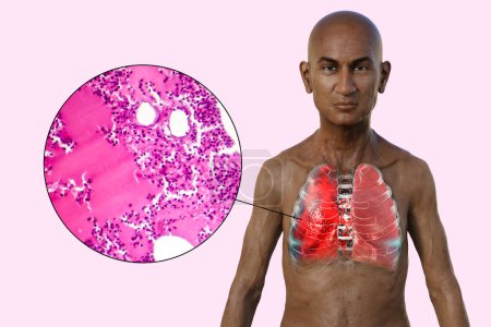 Foto de Una ilustración fotorrealista en 3D que muestra la mitad superior de un hombre con piel transparente, revelando los pulmones afectados por la neumonía, junto con una imagen micrográfica de neumonía. - Imagen libre de derechos