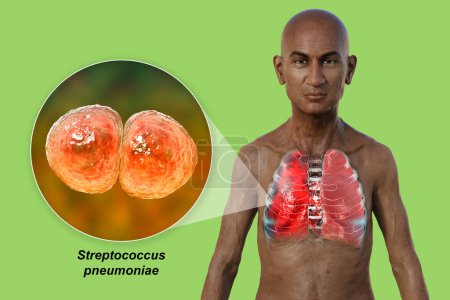 Photo for A 3D photorealistic illustration showcasing the upper half part of a man with transparent skin, revealing the lungs affected by pneumonia, and close-up view of Streptococcus pneumoniae bacteria. - Royalty Free Image