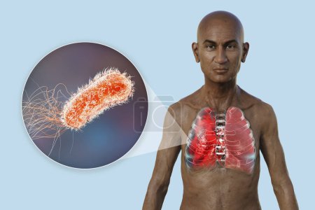 Photo for A 3D photorealistic illustration showcasing the upper half part of a man with transparent skin, revealing the lungs affected by pneumonia, and close-up view of Pseudomonas aeruginosa bacteria. - Royalty Free Image