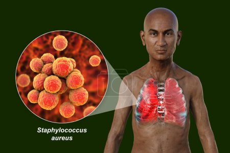 Foto de Una ilustración fotorrealista en 3D que muestra la mitad superior de un hombre con la piel transparente, revelando los pulmones afectados por la neumonía, y vista de cerca de la bacteria Staphylococcus aureus. - Imagen libre de derechos