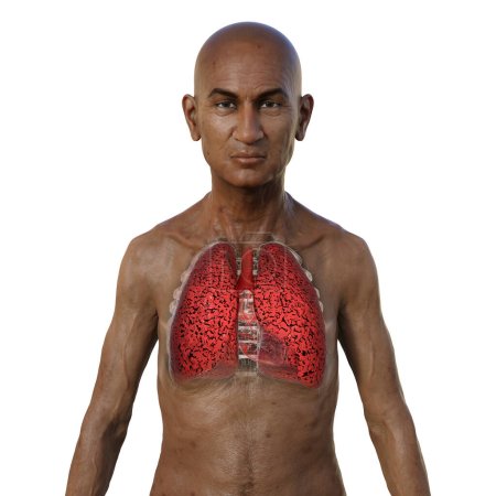 Téléchargez les photos : Illustration 3D de la moitié supérieure d'un homme à la peau transparente, révélant l'état des poumons du fumeur. - en image libre de droit