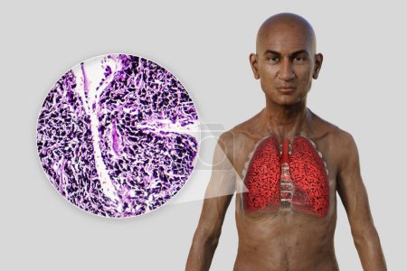 Foto de Una ilustración 3D de la mitad superior de un hombre con piel transparente, revelando la condición de los pulmones del fumador, junto con una imagen micrográfica de los pulmones afectados por el tabaquismo. - Imagen libre de derechos
