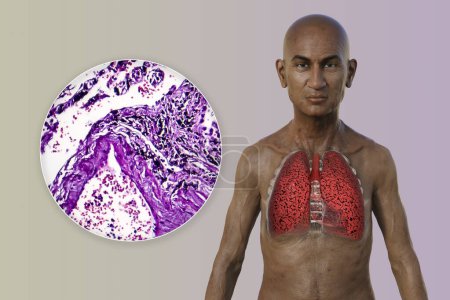 Photo for A 3D illustration of the upper half part of a man with transparent skin, revealing the condition of smoker's lungs, along with a micrograph image of lungs affected by smoking. - Royalty Free Image