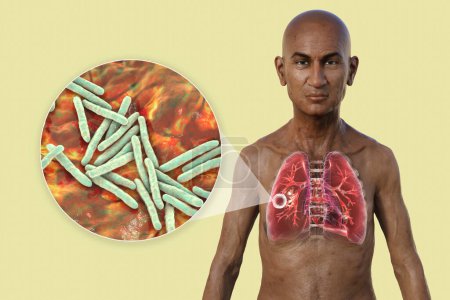 Téléchargez les photos : Illustration photoréaliste en 3D de la moitié supérieure d'un homme à peau transparente, montrant les poumons atteints de tuberculose caverneuse et vue rapprochée de la bactérie Mycobacterium tuberculosis. - en image libre de droit