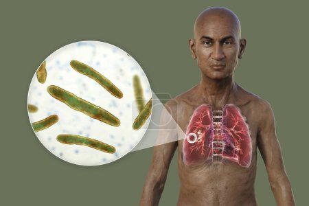 Photo for A 3D photorealistic illustration of the upper half of a man with transparent skin, showcasing the lungs affected by cavernous tuberculosis, and close-up view of Mycobacterium tuberculosis bacteria. - Royalty Free Image