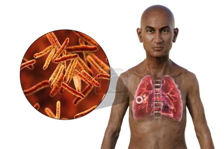 Photo for A 3D photorealistic illustration of the upper half of a man with transparent skin, showcasing the lungs affected by cavernous tuberculosis, and close-up view of Mycobacterium tuberculosis bacteria. - Royalty Free Image
