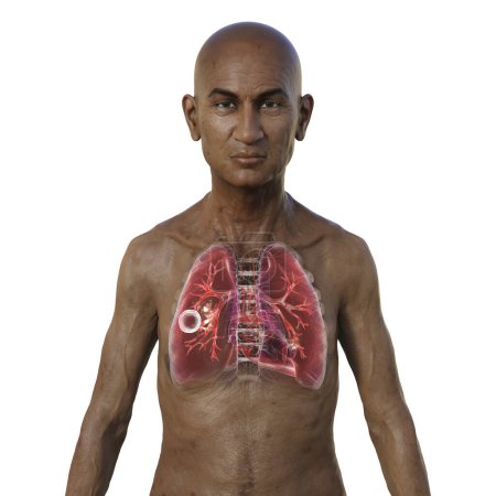 Photo for A 3D photorealistic illustration of the upper half of a man with transparent skin, showcasing the lungs affected by cavernous tuberculosis. - Royalty Free Image