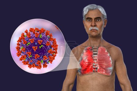 Photo for A 3D photorealistic illustration showcasing the upper half part of a man with transparent skin, revealing the lungs affected by Covid-19 pneumonia, and close-up view of SARS-CoV-2 viruses. - Royalty Free Image