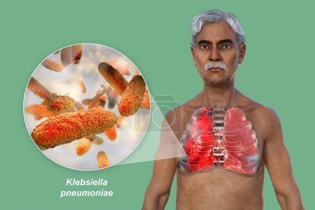 Photo for A 3D photorealistic illustration showcasing the upper half part of a man with transparent skin, revealing the lungs affected by pneumonia, and close-up view of Klebsiella pneumoniae bacteria. - Royalty Free Image
