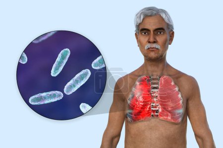 Foto de Una ilustración fotorrealista 3D que muestra la mitad superior de un hombre con la piel transparente, revelando los pulmones afectados por la neumonía, y la vista de cerca de la bacteria Klebsiella pneumoniae. - Imagen libre de derechos
