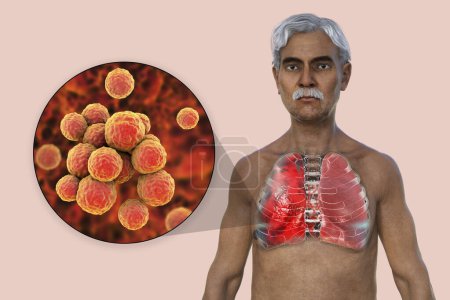 Téléchargez les photos : Illustration photoréaliste 3D montrant la moitié supérieure d'un homme à la peau transparente, révélant les poumons atteints de pneumonie, et vue rapprochée de la bactérie Staphylococcus aureus. - en image libre de droit