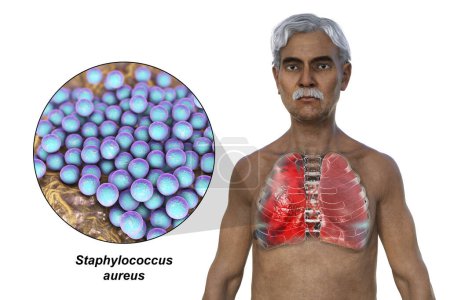 Photo for A 3D photorealistic illustration showcasing the upper half part of a man with transparent skin, revealing the lungs affected by pneumonia, and close-up view of Staphylococcus aureus bacteria. - Royalty Free Image