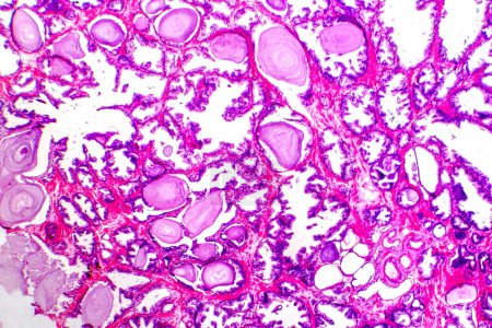 Photo for Micrograph of prostatic hyperplasia, showing increased glandular tissue. - Royalty Free Image