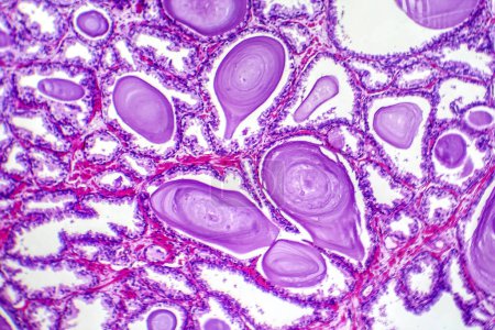 Téléchargez les photos : Micrographie de l'hyperplasie prostatique, montrant une augmentation du tissu glandulaire. - en image libre de droit