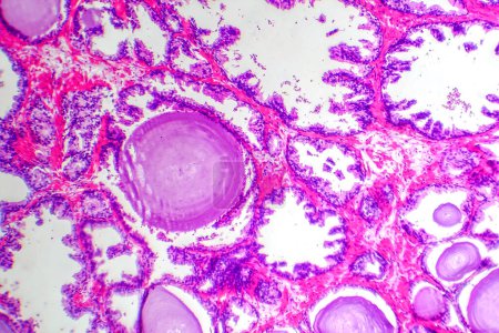 Téléchargez les photos : Micrographie de l'hyperplasie prostatique, montrant une augmentation du tissu glandulaire. - en image libre de droit