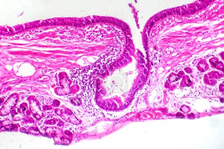 Foto de Fotomicrografía de metaplasia escamosa epitelial bronquial, mostrando transformación de células escamosas en el revestimiento respiratorio. - Imagen libre de derechos