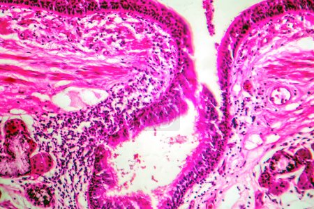 Foto de Fotomicrografía de metaplasia escamosa epitelial bronquial, mostrando transformación de células escamosas en el revestimiento respiratorio. - Imagen libre de derechos