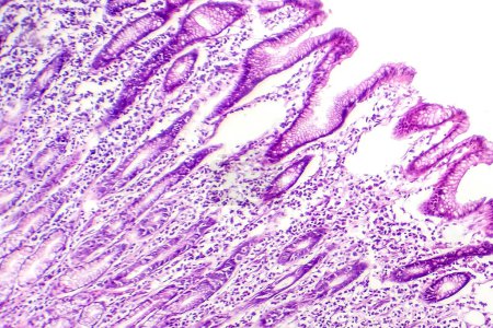 Téléchargez les photos : Photomicrographie de la métaplasie intestinale, montrant la transformation des cellules muqueuses de l'estomac en cellules intestinales. - en image libre de droit