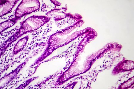Téléchargez les photos : Photomicrographie de la métaplasie intestinale, montrant la transformation des cellules muqueuses de l'estomac en cellules intestinales. - en image libre de droit