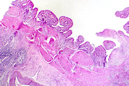 Photo for Photomicrograph of chronic cholecystitis, showcasing inflammation and structural changes in the gallbladder wall. - Royalty Free Image