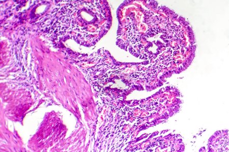 Fotografische Aufnahme einer chronischen Cholezystitis, die Entzündungen und strukturelle Veränderungen in der Gallenblasenwand zeigt.