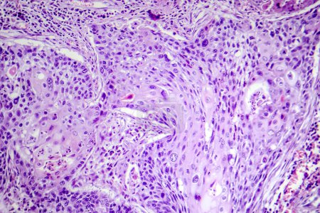 Foto de Fotomicrografía del carcinoma de células escamosas de pulmón, que muestra células escamosas malignas en el tejido pulmonar. - Imagen libre de derechos
