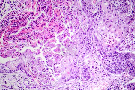 Foto de Fotomicrografía del carcinoma de células escamosas de pulmón, que muestra células escamosas malignas en el tejido pulmonar. - Imagen libre de derechos