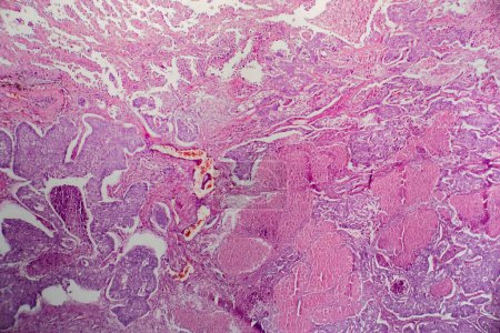 Téléchargez les photos : Photomicrographie de l'adénocarcinome pulmonaire, illustrant les cellules glandulaires malignes caractéristiques du type le plus courant de cancer du poumon. - en image libre de droit