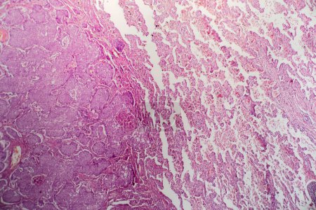 Photo for Photomicrograph of lung adenocarcinoma, illustrating malignant glandular cells characteristic of the most common type of lung cancer. - Royalty Free Image