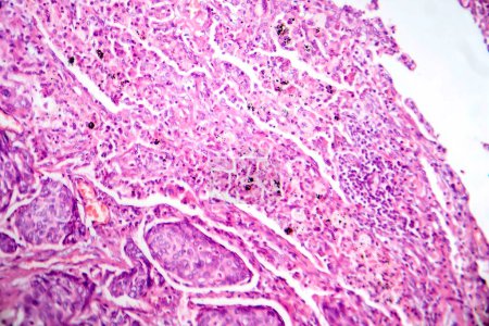 Foto de Fotomicrografía del adenocarcinoma de pulmón, que ilustra las células glandulares malignas características del tipo más común de cáncer de pulmón. - Imagen libre de derechos