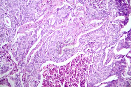 Foto de Fotomicrografía del adenocarcinoma de pulmón, que ilustra las células glandulares malignas características del tipo más común de cáncer de pulmón. - Imagen libre de derechos