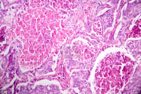 Photo for Photomicrograph of lung adenocarcinoma, illustrating malignant glandular cells characteristic of the most common type of lung cancer. - Royalty Free Image