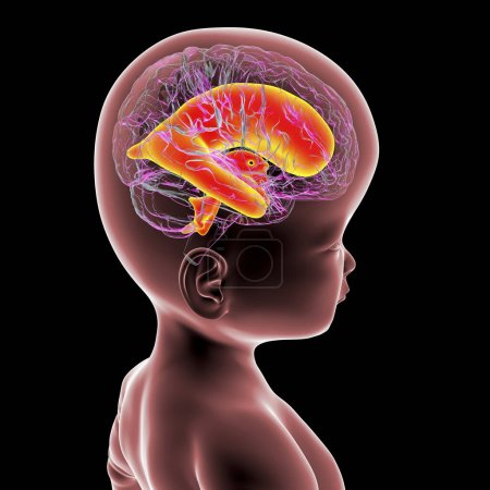 Téléchargez les photos : Illustration 3D scientifique d'un bébé présentant une macrocéphalie et des ventricules cérébraux élargis, une condition associée à une croissance anormale du cerveau. - en image libre de droit