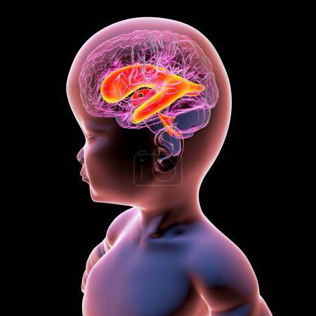 Téléchargez les photos : Illustration 3D scientifique d'un bébé présentant une macrocéphalie et des ventricules latéraux élargis, une condition associée à une croissance anormale du cerveau. - en image libre de droit