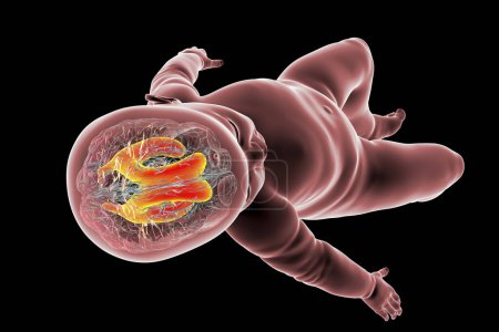 Foto de Ilustración científica en 3D de un bebé con macrocefalia y ventrículos laterales agrandados, una afección asociada con un crecimiento anormal del cerebro. - Imagen libre de derechos