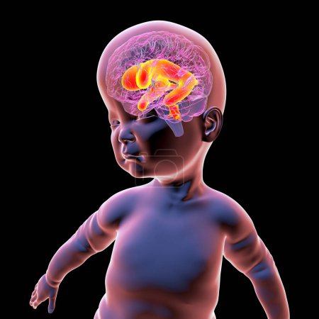 Téléchargez les photos : Illustration 3D scientifique d'un bébé présentant une macrocéphalie et des ventricules latéraux élargis, une condition associée à une croissance anormale du cerveau. - en image libre de droit