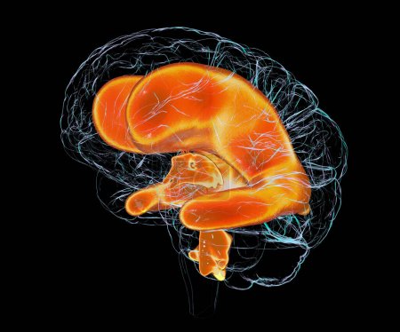 Foto de Una ilustración científica en 3D que representa ventrículos agrandados del cerebro del niño (hidrocefalia). - Imagen libre de derechos