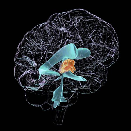 Foto de Una ilustración científica en 3D que representa el agrandamiento aislado del tercer ventrículo cerebral. - Imagen libre de derechos