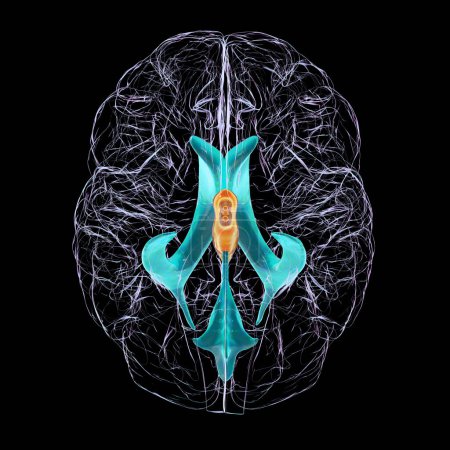 Foto de Una ilustración científica en 3D que representa el agrandamiento aislado del tercer ventrículo cerebral, vista inferior. - Imagen libre de derechos