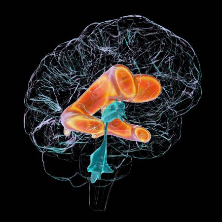 Téléchargez les photos : Illustration scientifique 3D représentant des ventricules latéraux élargis du cerveau (hydrocéphalie)). - en image libre de droit