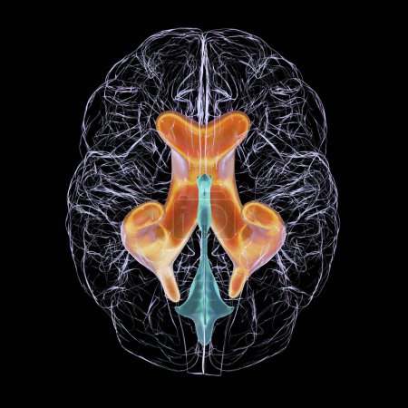 Téléchargez les photos : Illustration scientifique 3D représentant des ventricules latéraux élargis du cerveau (hydrocéphalie), vue du bas. - en image libre de droit