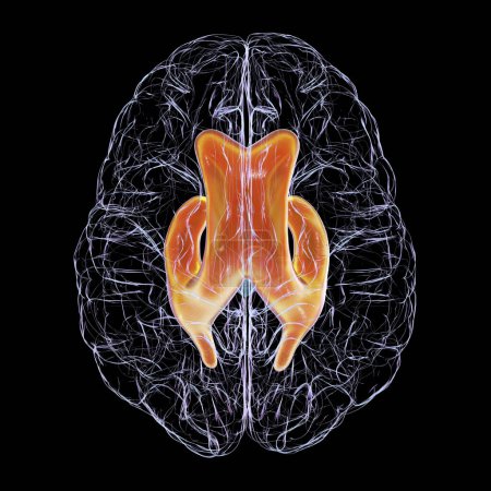 Foto de Una ilustración científica en 3D que representa ventrículos laterales agrandados del cerebro (hidrocefalia), vista superior. - Imagen libre de derechos